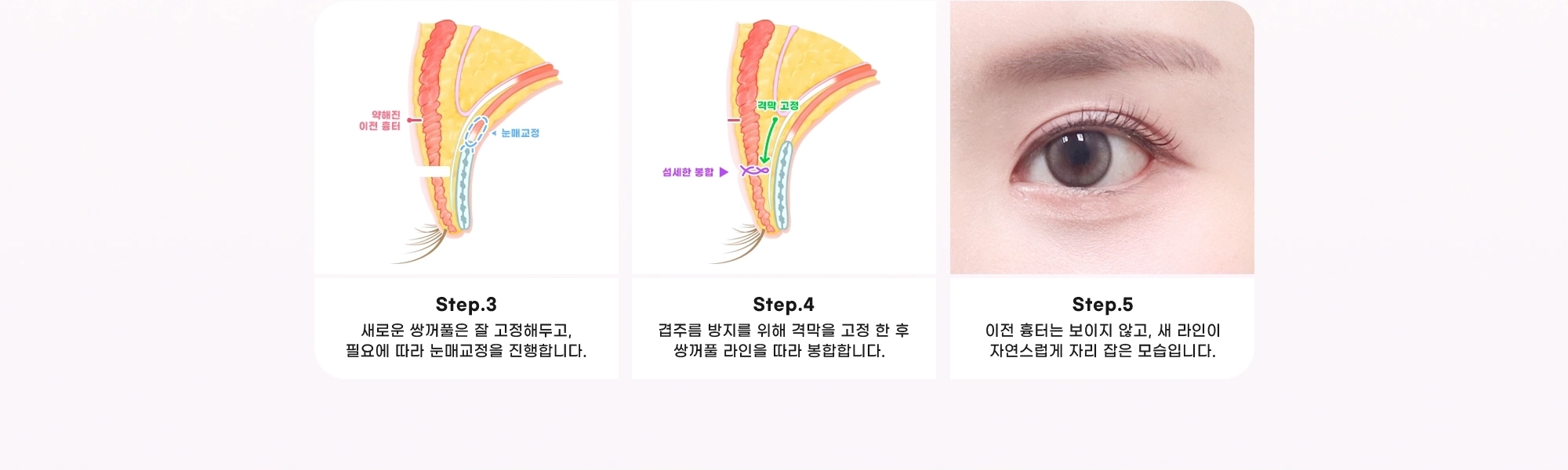 Step.3 새로운 쌍꺼풀은 잘 고정해두고, 필요에 따라 눈매교정을 진행합니다. Step.4 겹주름 방지를 위해 격막을 고정 한 후 쌍꺼풀 라인을 따라 봉합합니다. Step.5 이전 흉터는 보이지 않고, 새 라인이 자연스럽게 자리 잡은 모습입니다.