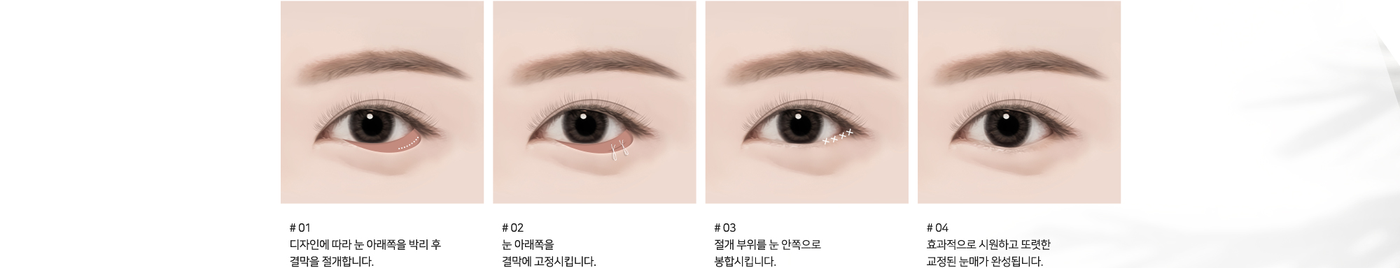 #01 디자인에 따라 눈 아래쪽을 박리 후 결막을 절개합니다. #02 눈 아래쪽을 결막에 고정시킵니다. #03 절개 부위를 눈 안쪽으로 봉합시킵니다. #04 효과적으로 시원하고 또렷한 교정된 눈매가 완성됩니다.