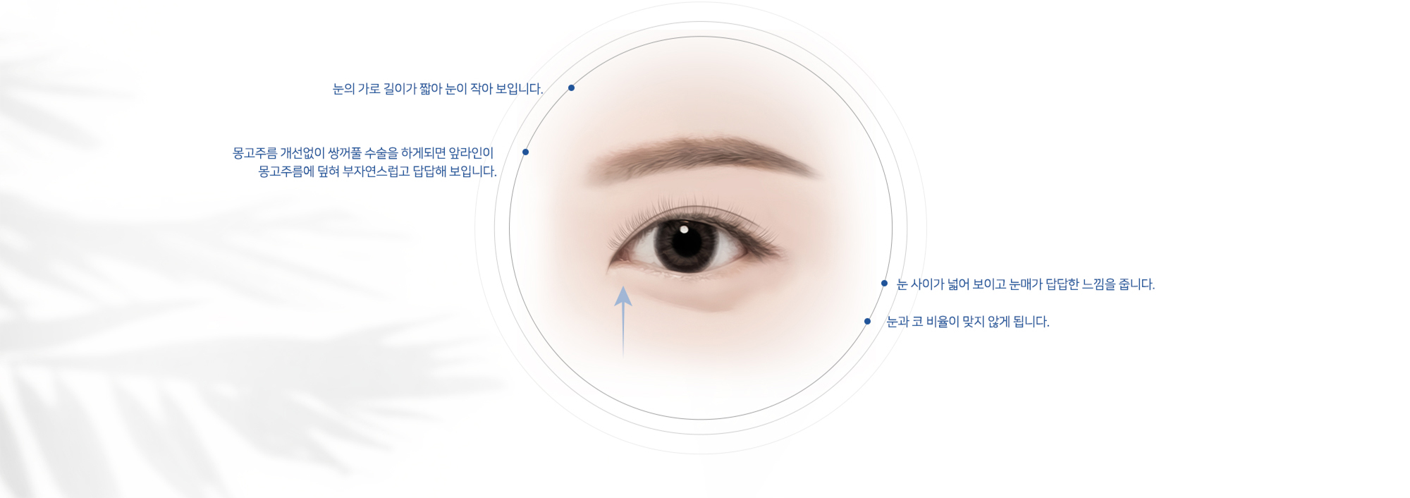 # 눈의 가로 길이가 짧아 눈이 작아 보입니다.   # 몽고주름 개선없이 쌍꺼풀 수술을 하게되면 앞라인이 몽고주름에 덮혀 부자연스럽고 답답해 보입니다.   # 눈 사이가 넓어 보이고 눈매가 답답한 느낌을 줍니다.   # 눈과 코 비율이 맞지 않게 됩니다.