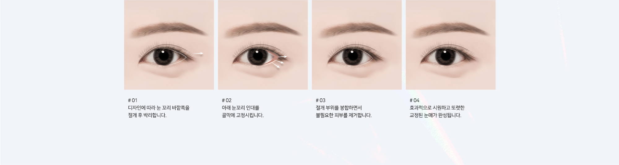 # 01 : 디자인에 따라 눈 꼬리 바깥쪽을 절개 후 박리합니다.   # 02 : 아래 눈꼬리 인대를 골막에 고정시킵니다.   # 03 : 절개 부위를 봉합하면서 불필요한 피부를 제거합니다.   # 04 : 효과적으로 시원하고 또렷한 교정된 눈매가 완성됩니다.