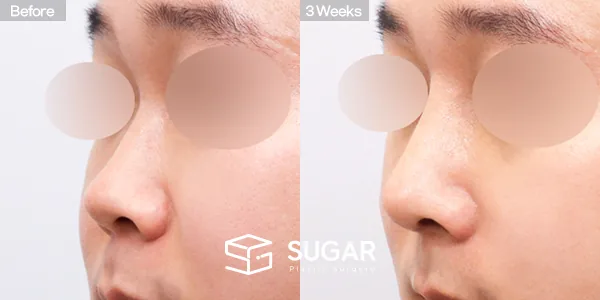 슈가성형외과 첫) 콧대 + 코끝 + 매부리코 + 귀연골 전후사진 - 45도 수술 전후 비교