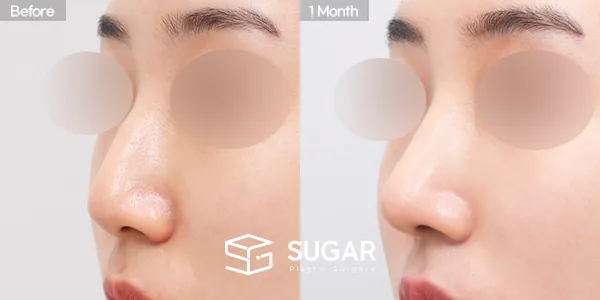 슈가성형외과 첫) 콧대 + 코끝 + 복코 + 매부리코 + 무보형물 코성형 + 절골 + 기증늑 전후사진 - 45도 수술 전후 비교