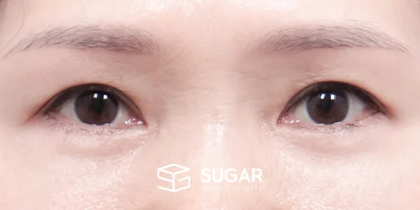 슈가성형외과 첫) 눈썹 거상 + 중안면부 거상 + 절개 + 하안검 전후사진 - 수술 후