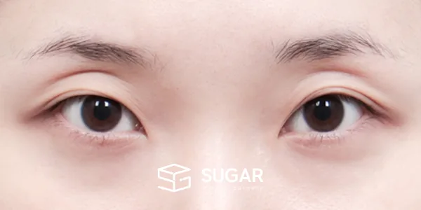 슈가성형외과 재) 자연유착 + 눈매교정 + 윗트임 + 뒤밑트임 + 재수술 전후사진 - 수술 전