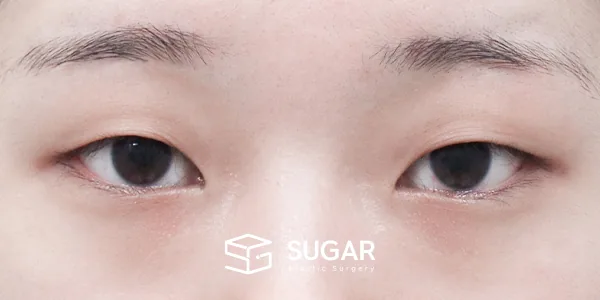 슈가성형외과 첫) 자연유착 + 눈매교정 전후사진 - 수술 전