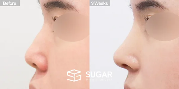 슈가성형외과 첫) 콧대 + 코끝 + 매부리코 + 절골 + 귀연골 전후사진 - 측면 수술 전후 비교