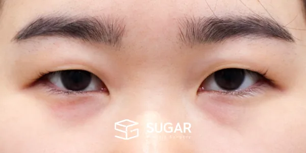 슈가성형외과 첫) 절개 + 앞트임 + 뒤밑트임 전후사진 - 수술 전