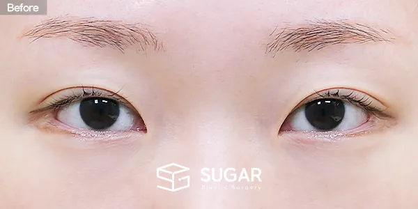 슈가성형외과 재) 재수술 + 뒤밑트임 전후사진 - 수술 전