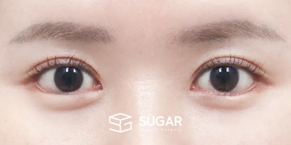 슈가성형외과 첫) 절개 + 뒤밑트임 전후사진 - 수술 후