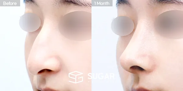 슈가성형외과 첫) 무보형물 + 콧대 + 코끝 + 매부리 + 비중격연장 + 귀연골 + 귀 뒤 근막 + 비순각교정 전후사진 - 45도 수술 전후 비교