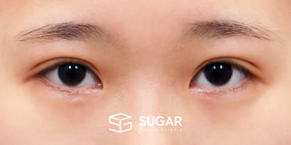 슈가성형외과 재) 재수술 + 절개(두 줄 따기) 전후사진 - 수술 전