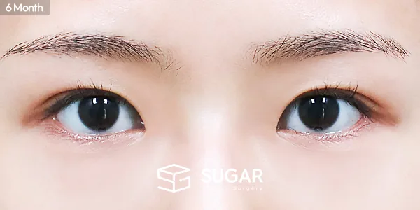 슈가성형외과 첫) 자연유착 + 눈매교정 전후사진 - 수술 후