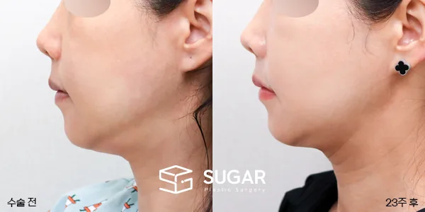 슈가성형외과 첫) 중안면부거상 + 이중턱 지방흡입 + 얼굴 지방이식 전후사진 - 전후 비교 사진