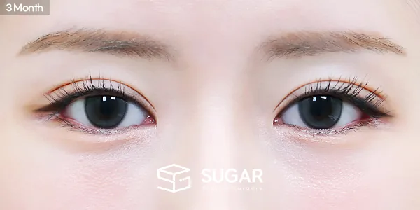 슈가성형외과 재) 재수술 + 자연유착 + 눈매교정 전후사진 - 수술 후