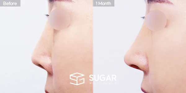 슈가성형외과 재) 재수술 + 콧대 + 코끝 + 기증늑 + 비중격연장 + 절골 전후사진 - 측면 수술 전후 비교