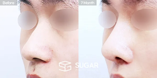 슈가성형외과 첫) 콧대 + 코끝 + 비중격연골 + 귀연골 + 매부리 + 복코 전후사진 - 45도 수술 전후 비교
