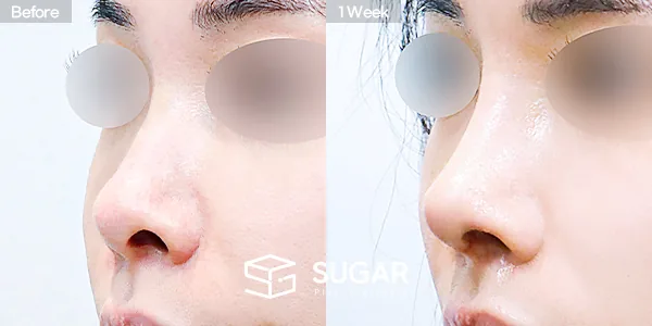 슈가성형외과 첫) 콧대 + 코끝 + 비중격연골 + 귀연골 + 복코 + 비공내리기 전후사진 - 45도 수술 전후 비교