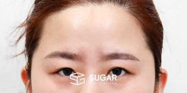 슈가성형외과 첫) 이마거상 + 뒷밑트임 전후사진 - 수술 전