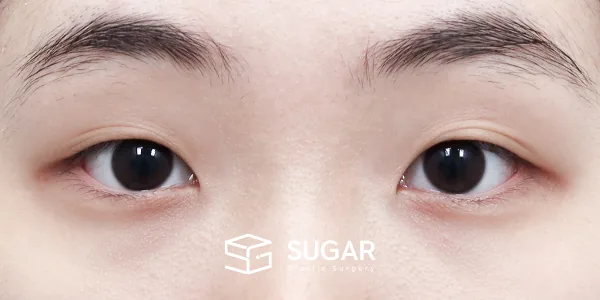 슈가성형외과 첫) 자연유착 + 앞트임 + 뒤밑트임 전후사진 - 수술 전