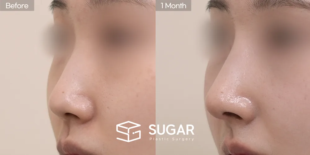 슈가성형외과 첫) 기증늑 + 귀연골 + 콧대 + 절골 + 복코 전후사진 - 45도 수술 전후 비교