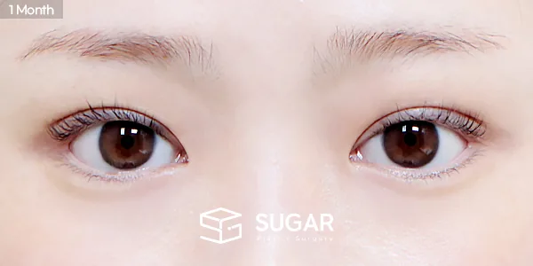 슈가성형외과 재) 재수술 + 절개 + 눈매교정 + 눈 두덩이 지방이식 전후사진 - 수술 후