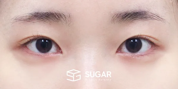 슈가성형외과 재) 재수술 + 자연유착 + 눈매교정 + 윗트임 전후사진 - 수술 전