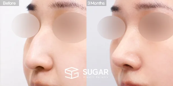 슈가성형외과 첫) 코끝 + 매부리코 + 비중격 + 귀연골 전후사진 - 45도 수술 전후 비교