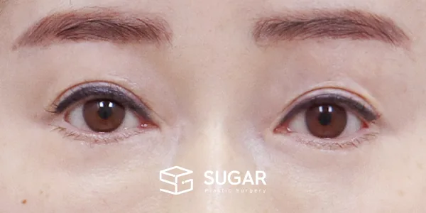 슈가성형외과 첫) 눈썹 거상 + 자연유착 전후사진 - 수술 후