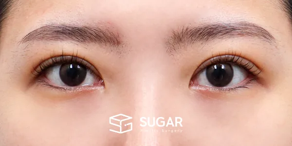 슈가성형외과 첫) 자연유착 + 눈매교정 전후사진 - 수술 후