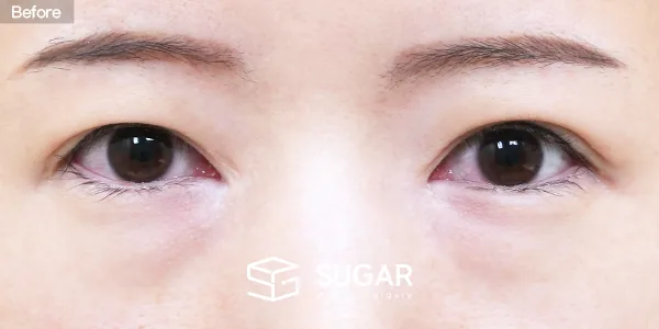 슈가성형외과 첫) 눈밑지방재배치 전후사진 - 수술 전