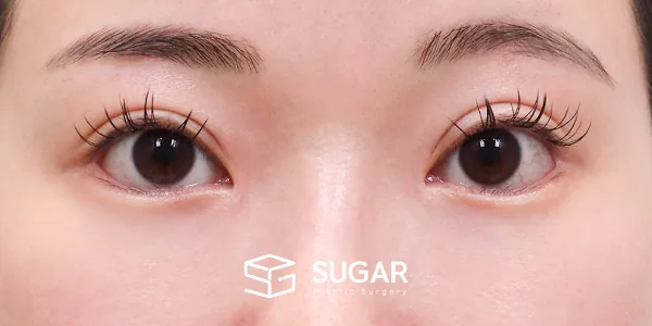 슈가성형외과 재) 재수술 + 뒤밑트임 + 눈 밑 지방재배치 전후사진 - 수술 후