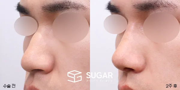 슈가성형외과 첫) 무보형물(코끝) + 매부리 + 복코 + 절골 + 비주 지지 + 비중격 연장 + 콧볼축소 + 근막 + 비중격 … 전후사진 - 45도 수술 전후 비교