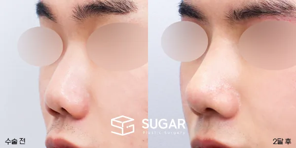 슈가성형외과 첫) 콧대코끝 + 매부리 + 복코 + 절골 + 기증늑 전후사진 - 45도 수술 전후 비교