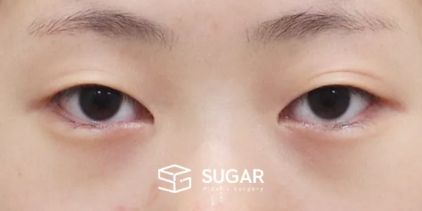 슈가성형외과 첫) 자연유착 + 눈매교정 전후사진 - 수술 전