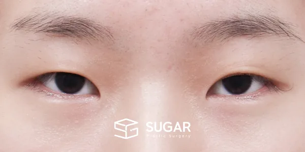 슈가성형외과 첫) 절개 + 앞트임 + 윗트임 + 뒤밑트임 전후사진 - 수술 전