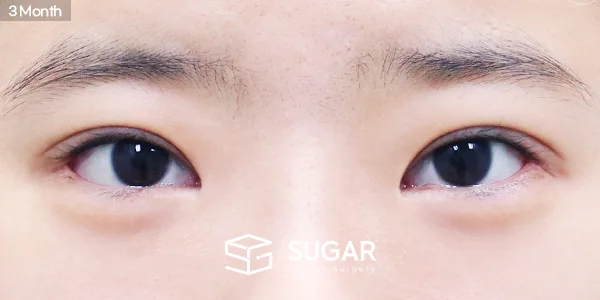 슈가성형외과 재) 재수술 + 절개 + 눈매교정 + 뒤밑트임 전후사진 - 수술 후