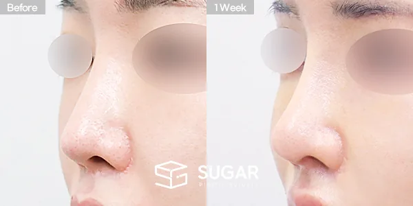 슈가성형외과 재) 재수술 + 콧대 + 코끝 + 기증늑 + 귀연골 + 귀 뒤 근막 전후사진 - 45도 수술 전후 비교