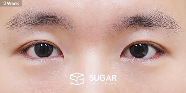슈가성형외과 첫) 자연유착 + 눈매교정 + 뒤밑트임 전후사진 - 수술 후