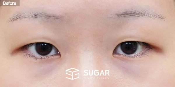슈가성형외과 첫) 자연유착 + 눈매교정 + 앞트임 전후사진 - 수술 전