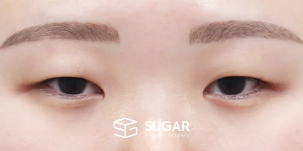 슈가성형외과 첫) 절개 + 앞트임 + 뒤밑트임 전후사진 - 수술 전