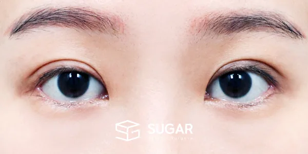 슈가성형외과 첫) 절개 + 윗트임 + 뒤밑트임 전후사진 - 수술 후