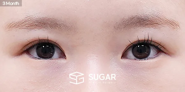 슈가성형외과 재) 재수술 + 절개 + 눈매교정 + 뒤밑트임 전후사진 - 수술 후