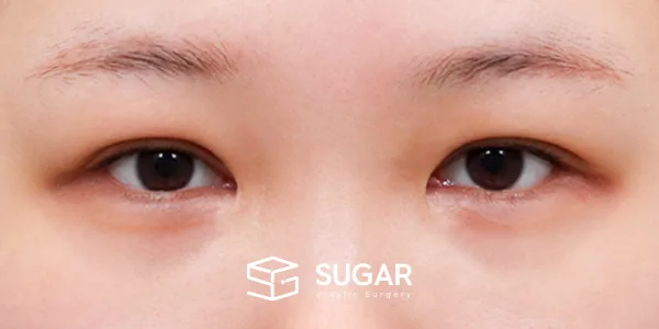 슈가성형외과 재) 재수술 + 뒤밑트임 전후사진 - 수술 전