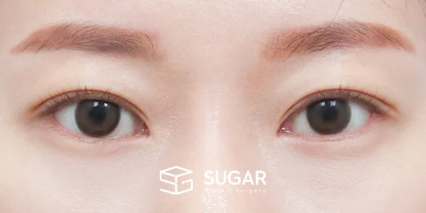 슈가성형외과 첫) 자연유착 전후사진 - 수술 후