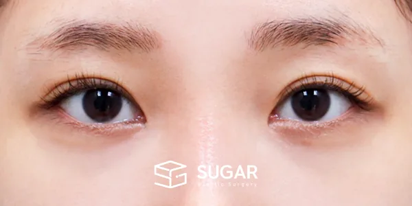 슈가성형외과 첫) 뒤밑트임 전후사진 - 수술 전