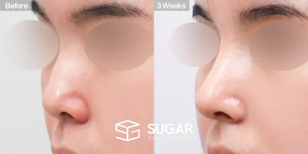 슈가성형외과 첫) 콧대 + 코끝 + 매부리코 + 절골 + 귀연골 전후사진 - 45도 수술 전후 비교
