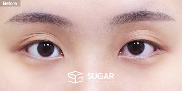 슈가성형외과 첫) 자연유착 + 눈매교정 + 앞트임 전후사진 - 수술 전