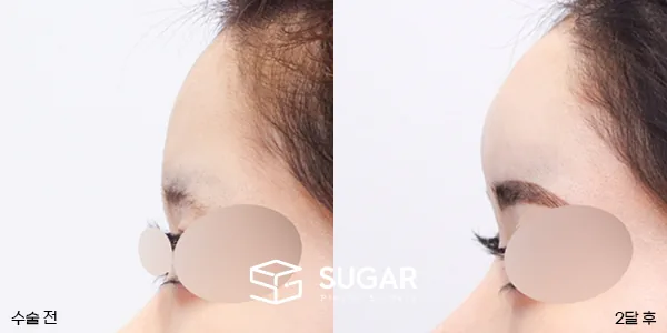 슈가성형외과 첫) 이마필러 전후사진 - 전후 비교 사진