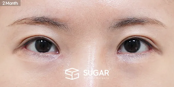 슈가성형외과 재) 앞트임 복원 + 뒤트임 재수술 전후사진 - 수술 후