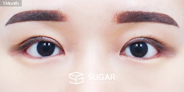 슈가성형외과 재) 재수술 + 절개 + 뒤밑트임 전후사진 - 수술 후